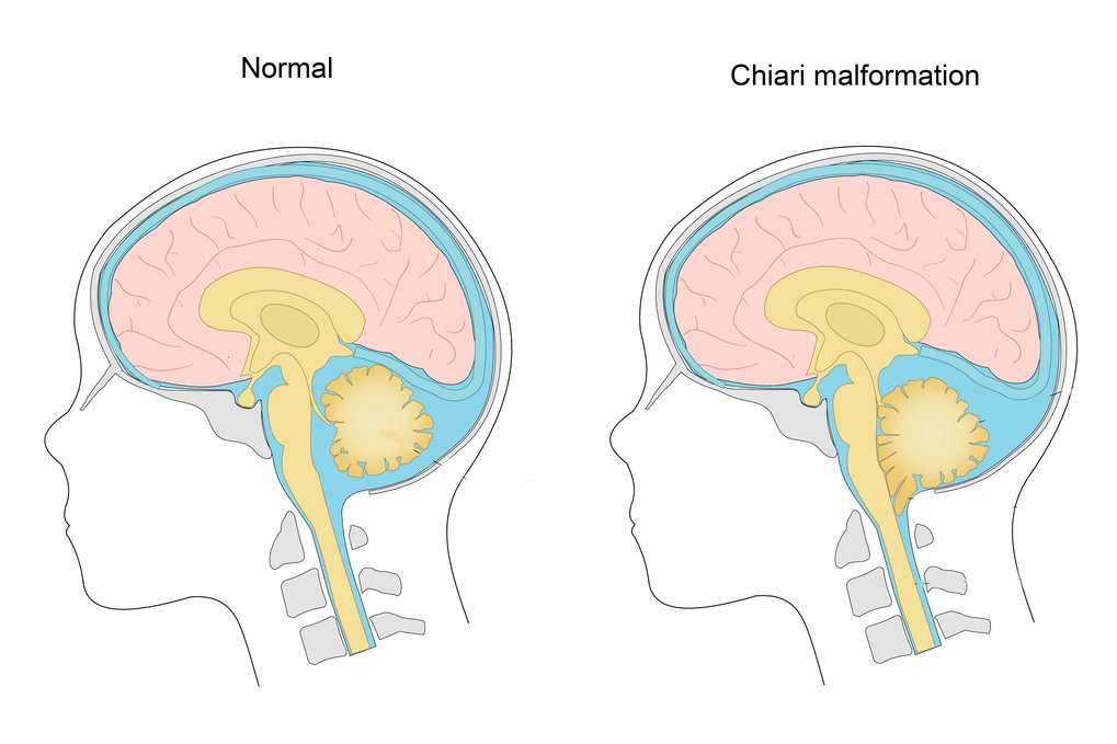 Chiari malformation - NHS