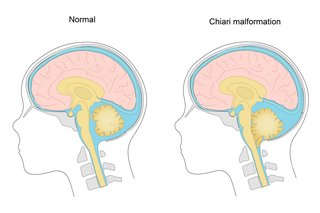An illustration showing 2 brains. One is normal. The other has Chiari malformation and shows the lower brain pushing forward and down into the spinal canal.