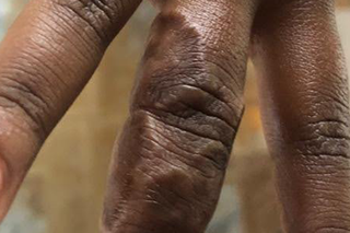 The first, second and third fingers of a person with dark brown skin. Several raised, circular areas of skin are visible on their middle finger.