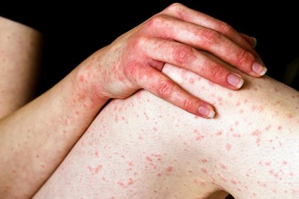 A rash of hives spots on the leg, arm and hand of a person with white skin. A long description is available next.