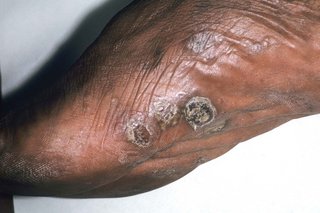 Pompholyx on the foot of someone with medium brown skin. They have some black blisters on their sole that are dry and crusty.