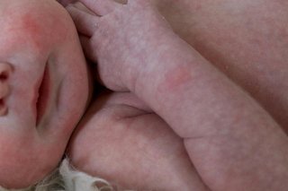 The shoulder and chin of a baby with white skin. Their skin is mottled with a purple and white patchy pattern like lace.
