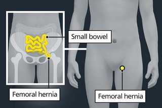 Illustration on the left of the small bowel (in yellow) passing through a gap in the pelvis. On the right is a yellow dot on the groin where a femoral hernia happens.