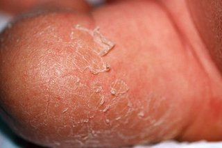 The left leg of a baby with peeling skin. The skin under the peeling skin is pink. Shown on white skin.
