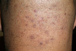Ingrown hairs shown on the back of the head on dark brown skin. The bumps are dark red and purple.
