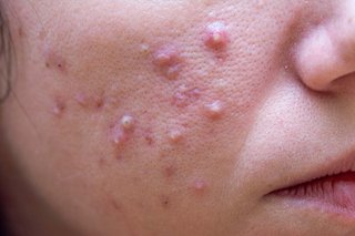 Cheek of a person with white skin who has acne. There are many raised pink bumps filled with pus (pustules).