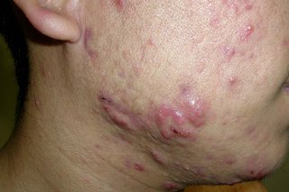 Cheek of a person with light olive skin who has acne. There are many raised bumpy patches along the jawline (nodules).