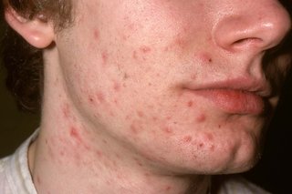 The lower face and neck of a person with white skin who has acne. There are many small raised red bumps (papules).