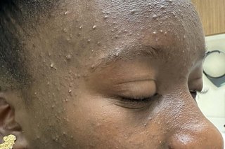 The forehead and face of a person with black skin who has acne.  The forehead and right side of their face is covered in small skin-coloured bumps (whiteheads).
