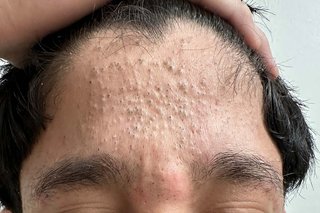 The forehead of a person with light olive skin affected by acne. There are many small brown and black dots (blackheads).