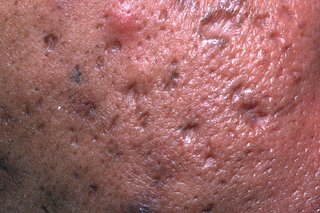 The cheek of someone with medium brown skin who has acne and acne scars. There are dips in their skin, some of which are darker than the surrounding skin.