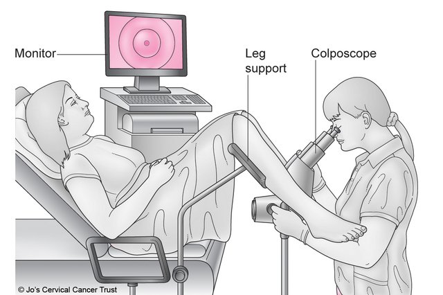 Colposcopy What Happens Nhs 