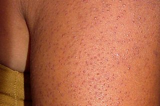 Small bumps close together on the back of the arm, shown on brown skin. The bumps are the same colour as the skin.