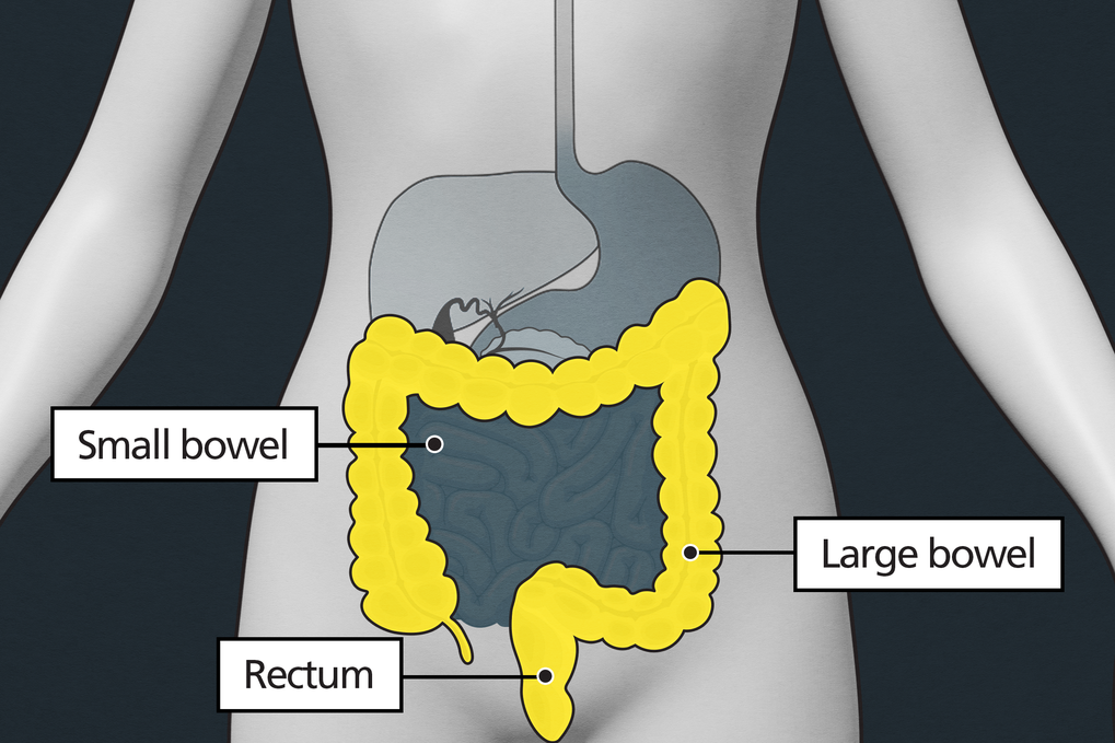 what-is-bowel-cancer-nhs