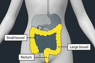 Diagram of the tummy area with labels showing the small bowel, large bowel and rectum. The large bowel and rectum are highlighted to show they can be affected by bowel cancer.