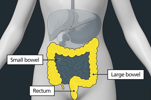 Diagram of the tummy area with labels showing the small bowel, large bowel and rectum. The large bowel and rectum are highlighted to show they can be affected by bowel cancer.