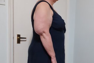 Side view of a person with white skin with an enlarged upper arm caused by lipoedema.