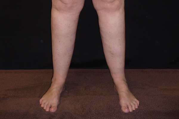 ARE FAT LEGS AT PUBERTY AN EARLY SIGN OF LIPEDEMA? - Total
