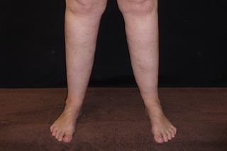A person with white skin with enlarged lower legs caused by lipoedema. Their feet are not affected.
