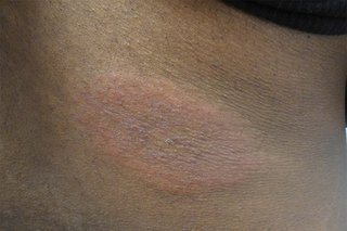 A round, raised rash with a slightly darker centre, on the upper arm, caused by Lyme disease. Shown on black skin.