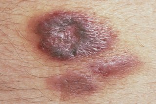 Close-up photo of a purple lesion on white skin