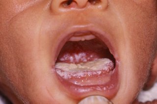White coating on the top of a child's tongue.