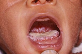 mild oral candidiasis