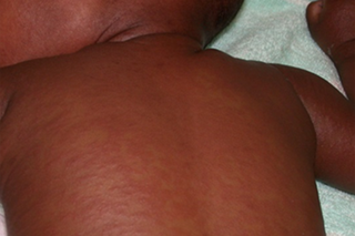 The measles rash on the back of a child with dark brown skin. The rash looks like dark red to brown, slightly raised, blotchy patches covering the child’s back.