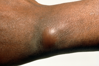 A boil about 2cm wide on the wrist of a person with dark brown skin. It is raised and the skin around it is darker.