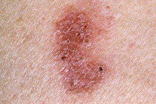 hpv itchy skin)