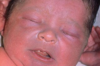 Baby's face with skin that's slightly blue around their mouth, nose and eyes. Shown on white skin.