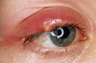 The stye is a yellow lump on the upper lid by the eyelashes. The upper eyelid is very swollen and red.