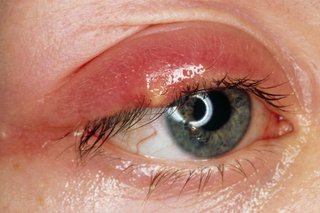 A red, swollen upper eyelid with a small, yellow stye on the lash line. Shown on white skin.