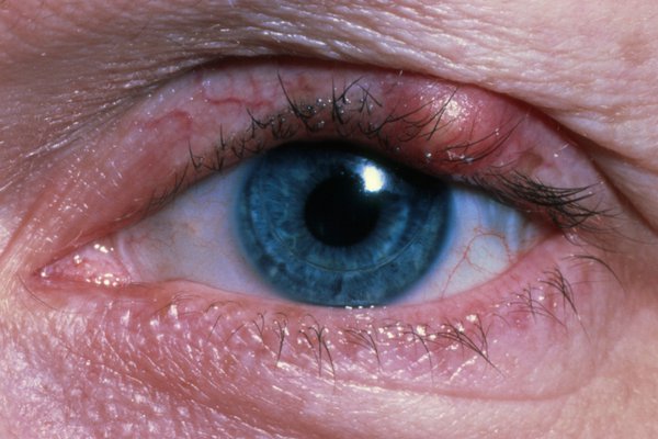 Stye on upper eyelid