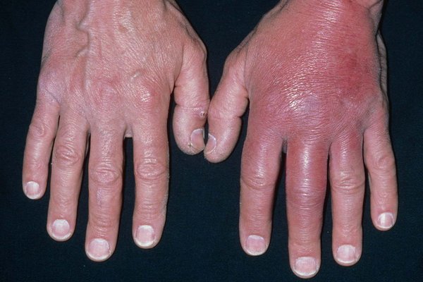 Picture of cellulitis