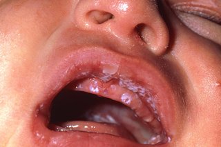 White spots inside a baby's mouth
