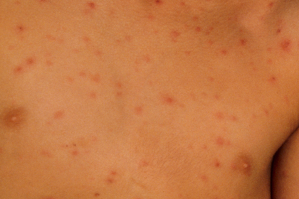 Stage 1 chickenpox on light brown skin with red or pink spots. A long description is available next.