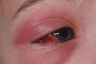 Red, swollen skin around the eye. The white part of the eye has also become red. Shown on white skin.