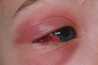 Red, swollen skin around the eye. The white part of the eye has also become red. Shown on white skin.