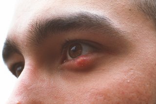 Stye on lower eyelid. It is a round, red lump by the lower eyelashes. The rest of the eye looks normal.