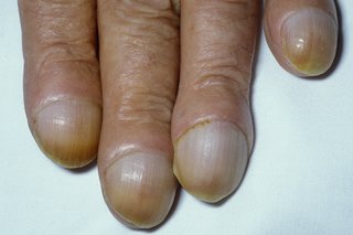A close-up of 4 clubbed fingernails. The nails have grown very large and curve over the end of the fingers, covering the fingertips.