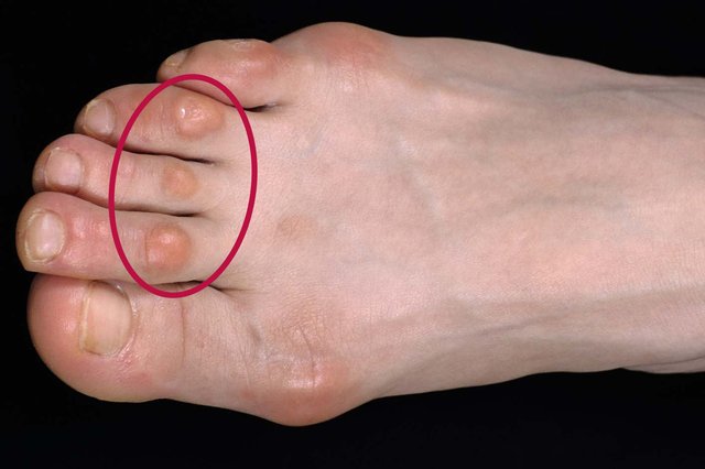 dry skin on top of big toe