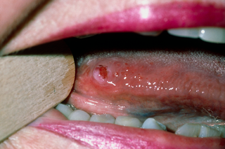 Close up of cancer on the tongue. There is a pale-coloured, pea-sized lump with redness on the side of the tongue.