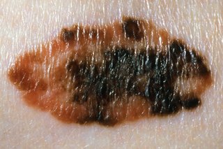 Close-up of a multicoloured melanoma on white skin. The melanoma is a mix of brown and black.