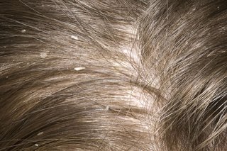 A close-up of dandruff in someone with white skin and brown hair. Several white flakes of skin can be seen in the person's hair.