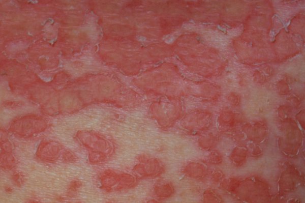 An area of white skin with a large number of small, raised pink or red patches. The patches are irregular shapes and close together.