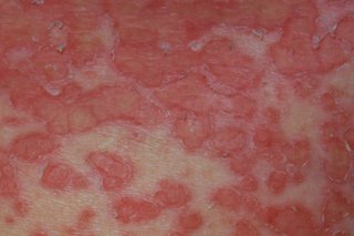 Picture of eczema herpeticum rash