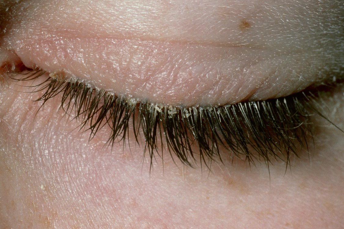 Blepharitis NHS