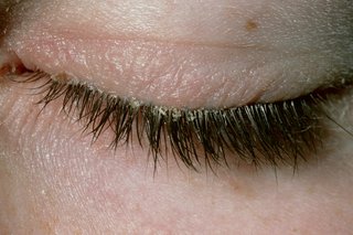 Blepharitis in someone with white skin. There are flakes of skin and crusts along the eyelid and eyelashes, and the eyelid looks slightly red.