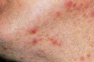 Close up of several ingrown hairs the neck and chin of a man with white skin.